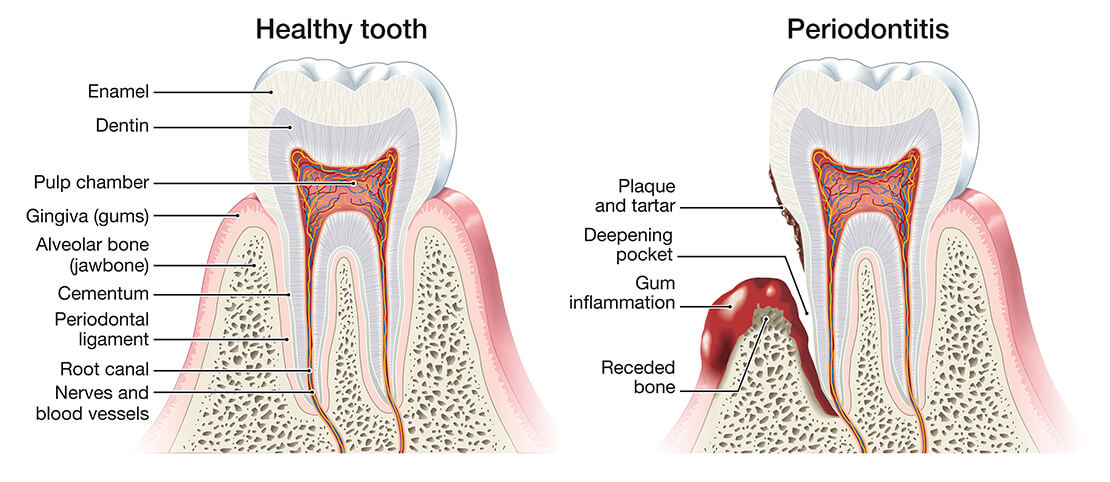 periodontitis-comparison