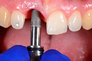 Classification of periodontal health and conditions